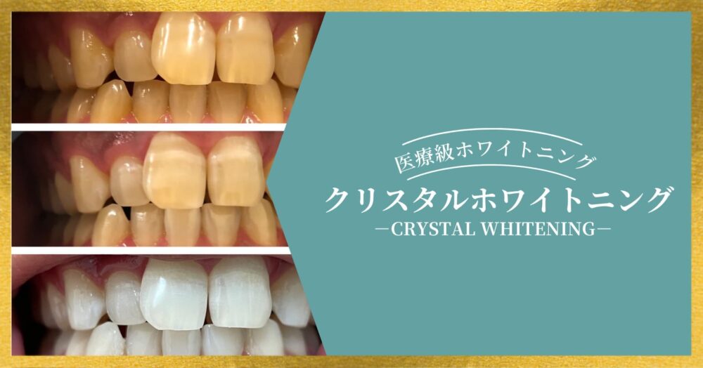 クリスタルホワイトニングのイメージ写真