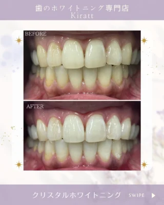 ゼロクリスタル ホワイトニング 85975-394-