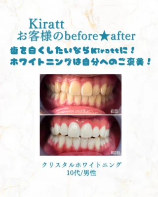 お客様の美歯口＆クリスタルホワイトニングの事例と頂いた感想