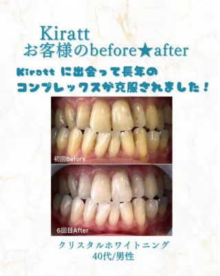 公式】歯のホワイトニング専門店『ホワイトニングサロンKiratt 高岡店