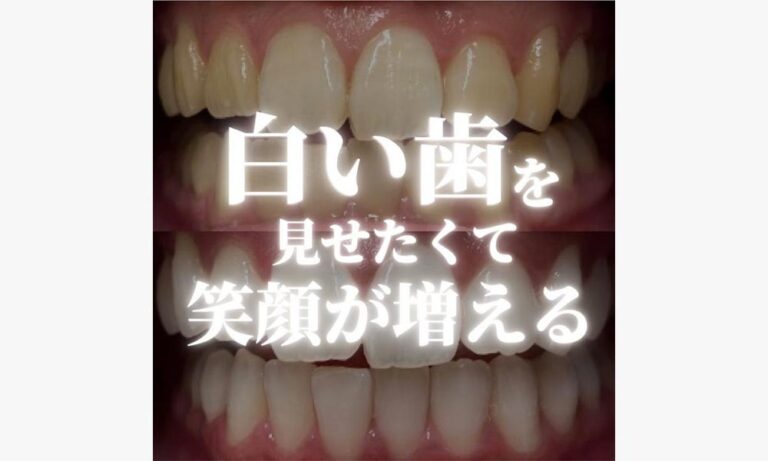 白い歯を見せたくて笑顔が増える【ビフォーアフター】