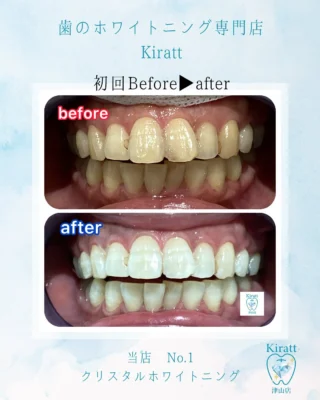 公式】歯のホワイトニング専門店『ホワイトニングサロンKiratt 津山店