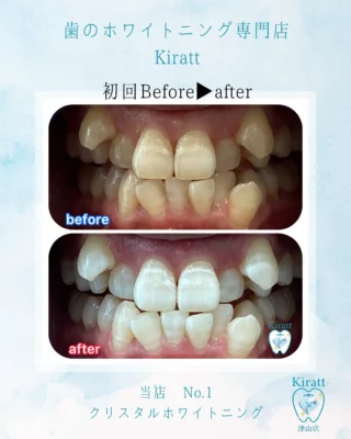 お客様の美歯口＆医療級ホワイトニングの事例と頂いた感想