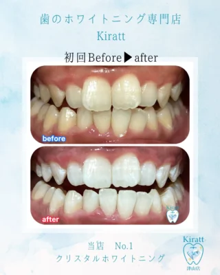 公式】歯のホワイトニング専門店『ホワイトニングサロンKiratt 津山店