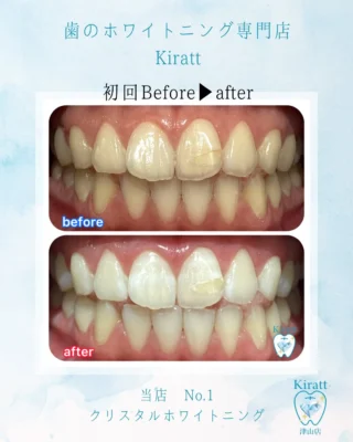 公式】歯のホワイトニング専門店『ホワイトニングサロンKiratt 津山店