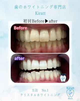 お客様の美歯口＆医療級ホワイトニングの事例と頂いた感想