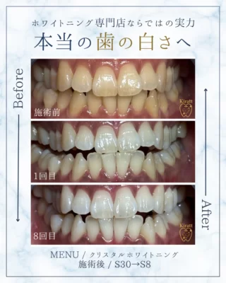 お客様の美歯口＆医療級ホワイトニングの事例と頂いた感想