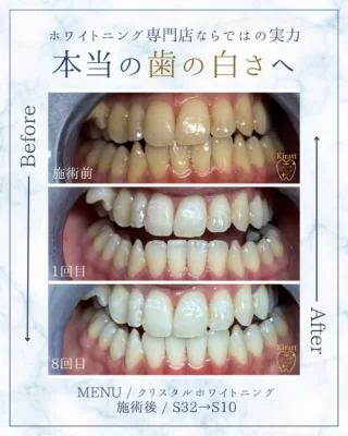 お客様の美歯口＆医療級ホワイトニングの事例と頂いた感想
