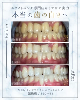 お客様の美歯口＆医療級ホワイトニングの事例と頂いた感想