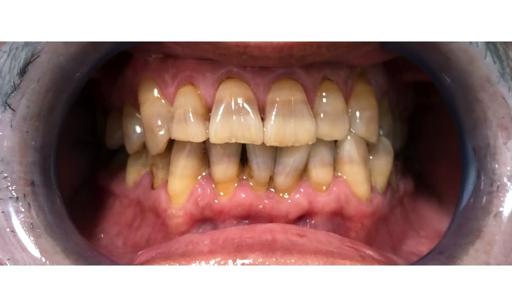 テトラサイクリン歯の写真