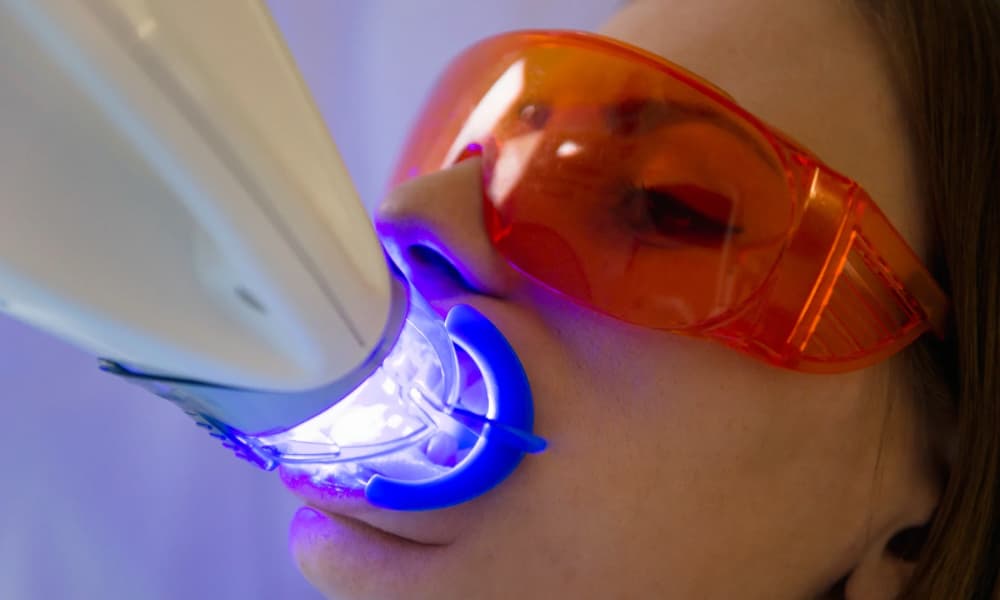 ホワイトニングで歯にLEDライトを照射している女性の画像